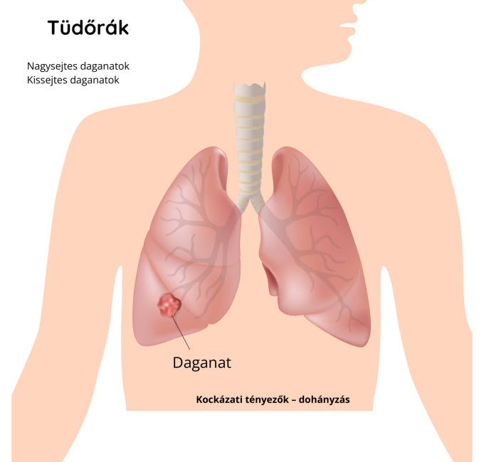 Tüdőrák