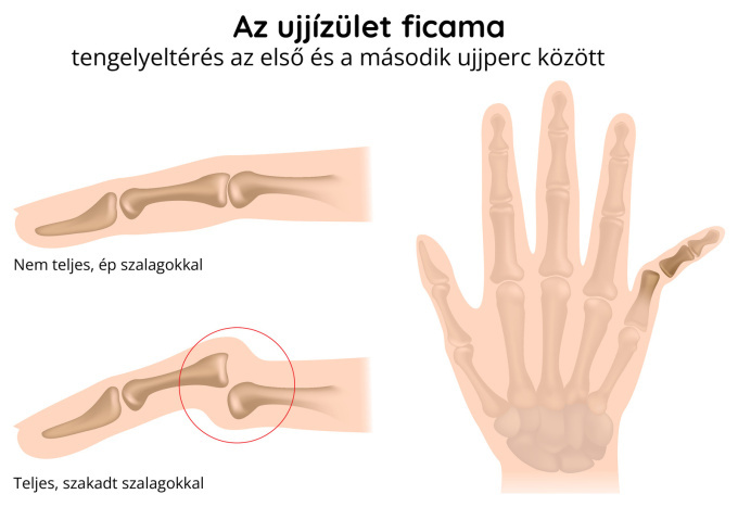 Ujjízület ficama