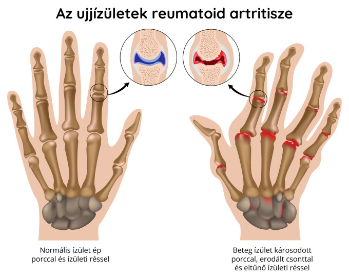 Reumatoid artritisz által érintett ujjízületek