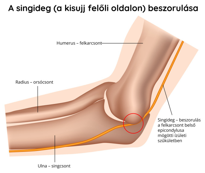 Az ulnaris ideg becsípődése
