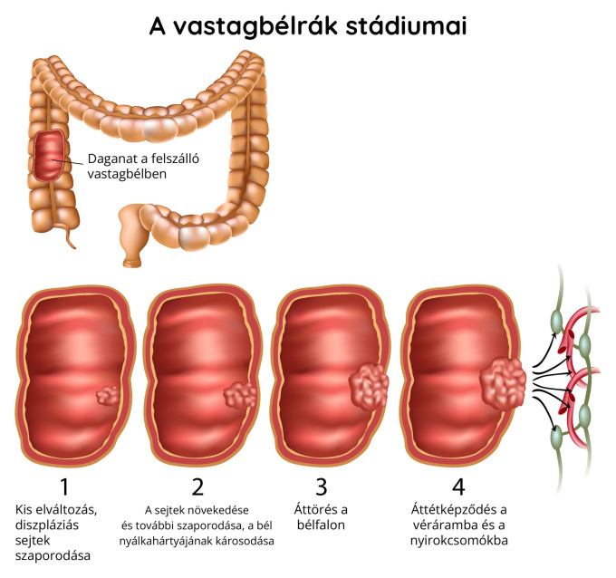A vastagbélrák stádiumai