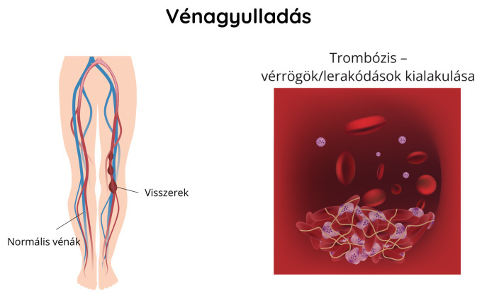 Vénagyulladás
