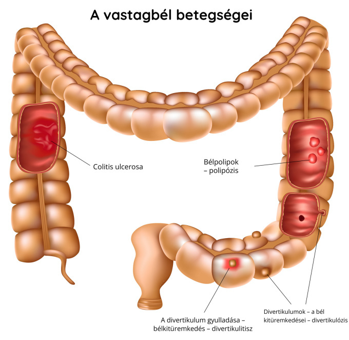 A vastagbél betegségei (ulceratív kolitisz, bélpolipok, divertikulumgyulladás)