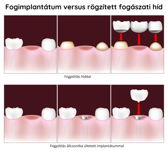 Fogászati implantátum vagy fix fogpótlás (híd)