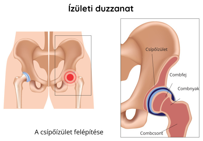 A csípőízület duzzanata