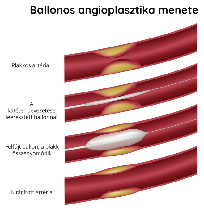 Ballonos angioplasztika – a beavatkozás menete