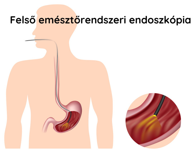 Gasztroszkópia
