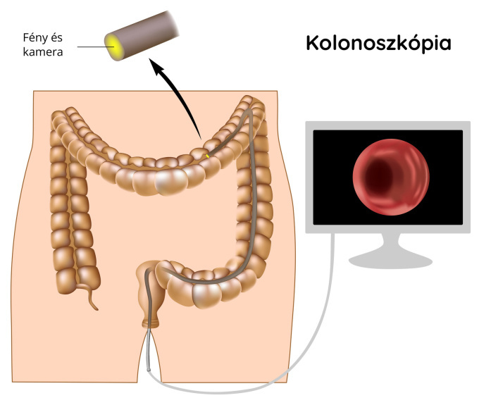 Kolonoszkópia / koloszkópia
