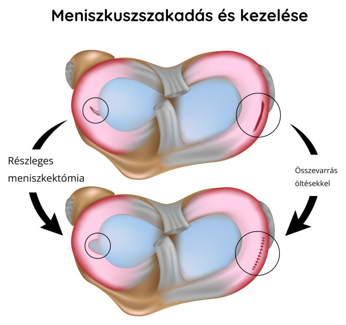 Szakadt meniszkusz – műtéti kezelés