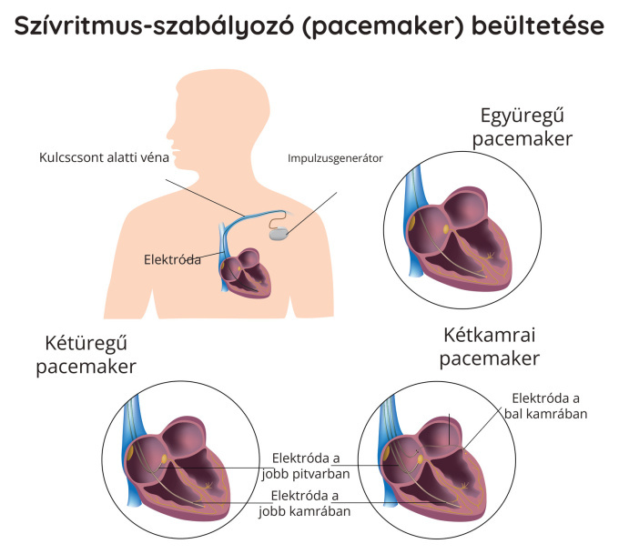 Pacemaker beültetése.